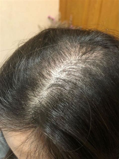脱发怎么办吃什么能长发？引起脱发的原因有哪些？ – 生发垂直网