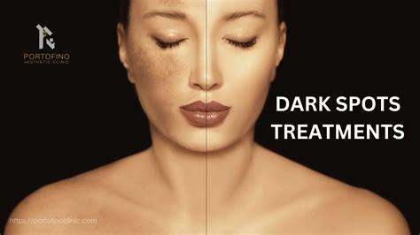 Dark Spots Removal Treatments[Best in Dubai]- Portofino Clinic