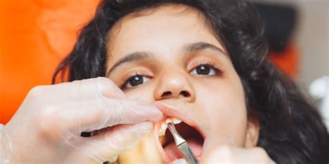 Root Canal in kids | Expert dentist for kids explain it all- Smile ...
