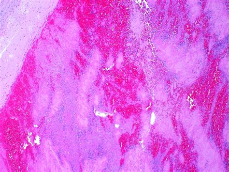Pathology Outlines - Infarct / pulmonary emboli