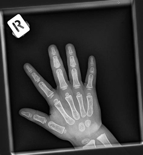 Child Hand X Ray at Dawn Wilkerson blog