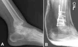Ankle Fractures (Broken Ankle) - OrthoInfo - AAOS