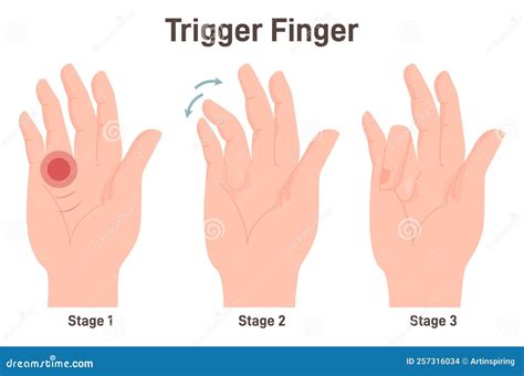 Finger Stiffness And Locking