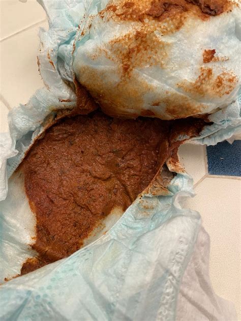 Pinworms In Toddler Poop