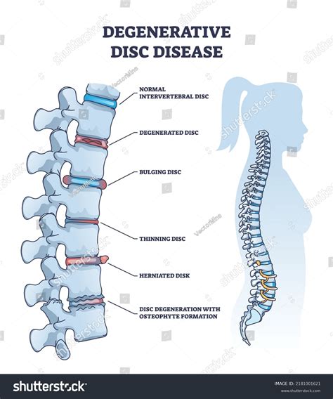 212 Degenerative Disc Concept Images, Stock Photos & Vectors | Shutterstock