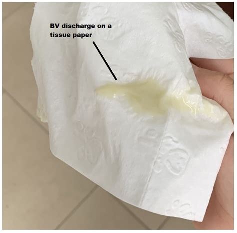 Bacterial Vaginosis (BV) Discharge Pics: Infection Vaginitis - STD ...