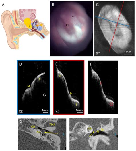Optical Coherence Tomography Imaging and Angiography of Skull Base ...