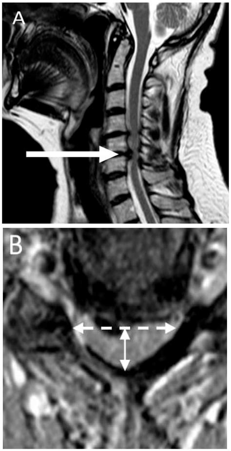 Vertigo in Patients with Degenerative Cervical Myelopathy