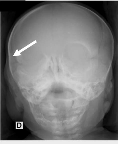 Depressed Skull Fracture