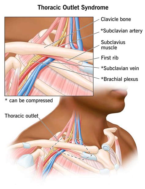 Thoracic Outlet Syndrome - Dr Karthikeyan Damodharan