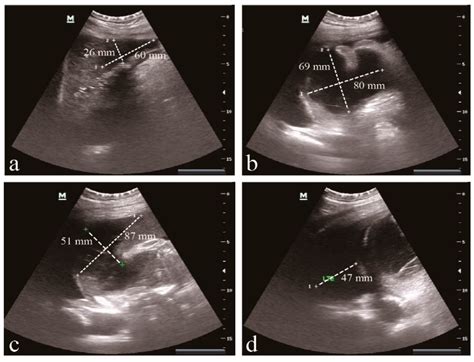 Clinical and Molecular Analysis of ST11-K47 Carbapenem-Resistant ...