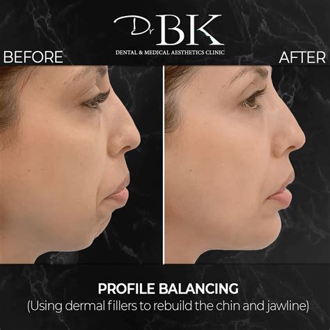Enhance Your Jawline with Jawline Fillers at the DrBK Clinic