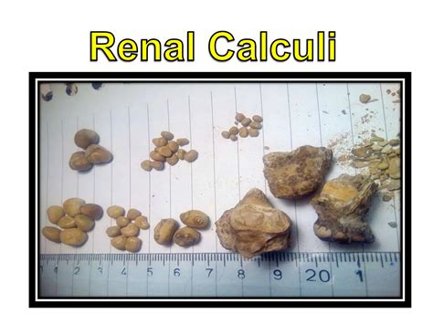 Renal Calculi , nephrolithiasis, kidney stone | PPTX