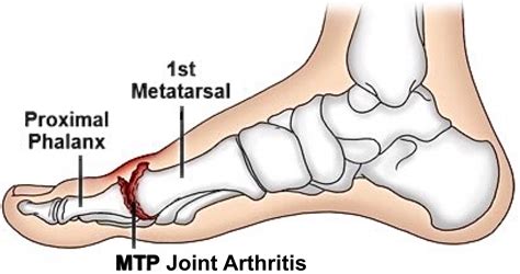 PhysioMSK: Big Toe Osteoarthritis : Hallux Rigidus / Limitus