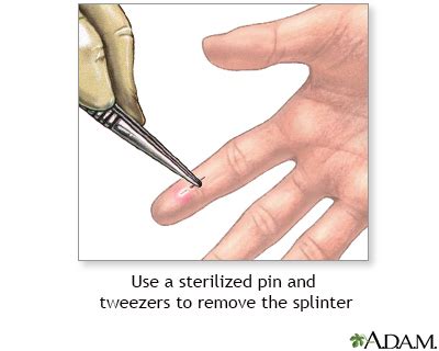 Image result for Remove Splinter