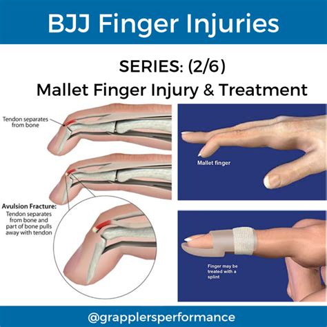 Bjj Sprained Finger at Lachlan Macadie blog