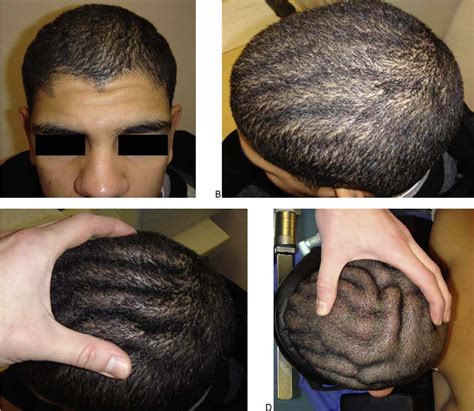 Cutis verticis gyrata causes, symptoms, treatment & prognosis