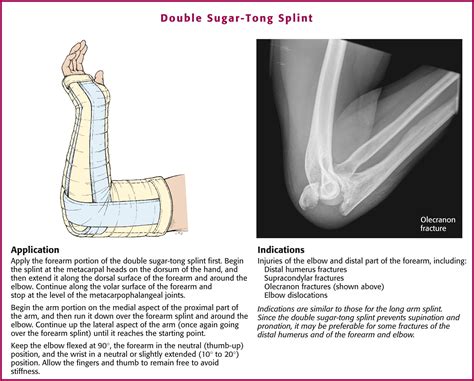 Splinting Techniques - Clinical Tree