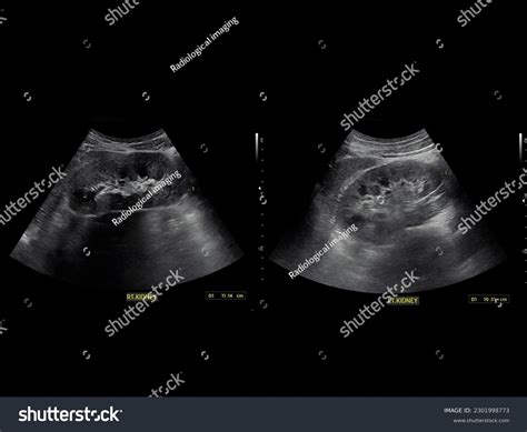 Kidney Stone Ultrasound