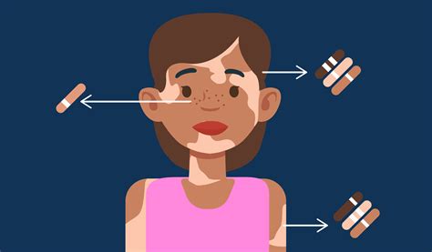 Polygenic Traits Definition