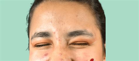 Facial Bumps: Causes and Solutions for Bumps on Your Face | The Pink ...