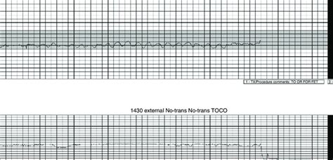 Fetal heart rate tracing demonstrating a sinusoidal fetal heart rate ...