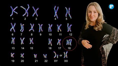 What is trisomy 18, the condition causing a Texas woman to flee the ...