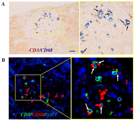 Concept and Diagnostic Challenges of Renal-Limited Hemophagocytic ...