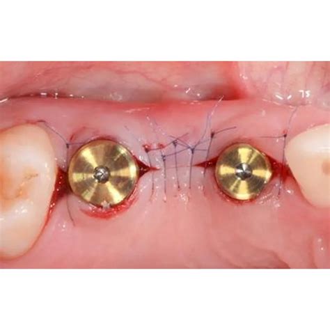 Buy Adin CloseFit NP Slim Healing Abutment 3mm – Oralkart