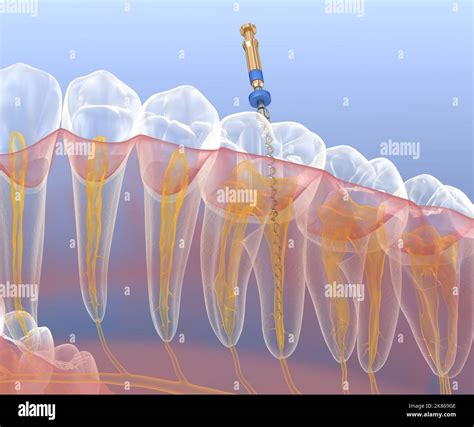 What Is Used In Endodontic Treatment For Cleansing Root Canals at Ruben Ramos blog