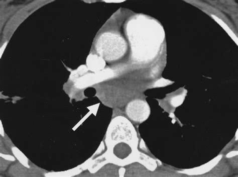 Multislice Helical CT of Focal and Diffuse Lung Disease Comprehensive ...