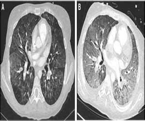 Case of Pulmonary edema secondary to severe hypalbuminemia in a young ...