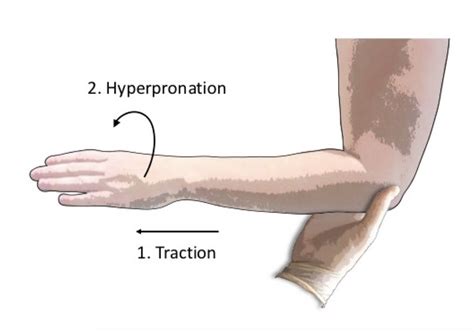 A Comparison Of Supinationflexion To Hyperpronation In