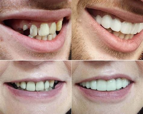Clip on veneers are a removable appliance that corrects the color and ...