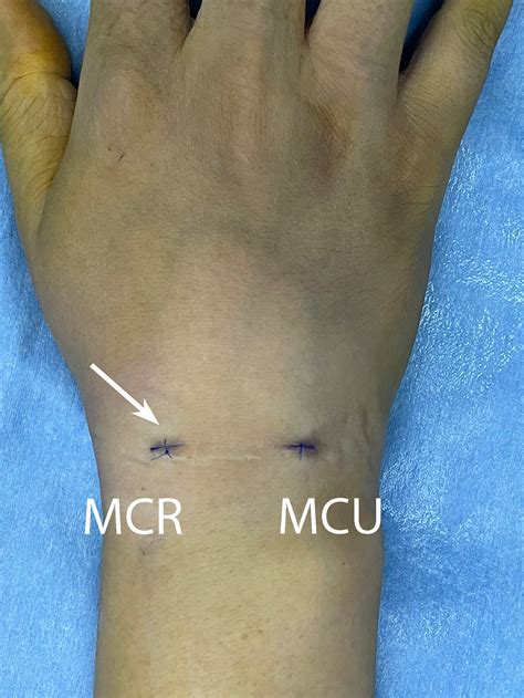 Ganglion Cyst Removal