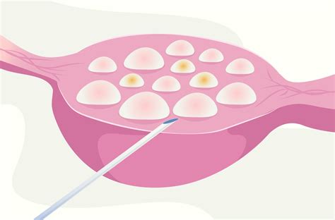 IVF Egg Retrieval Process: What You Need to Know