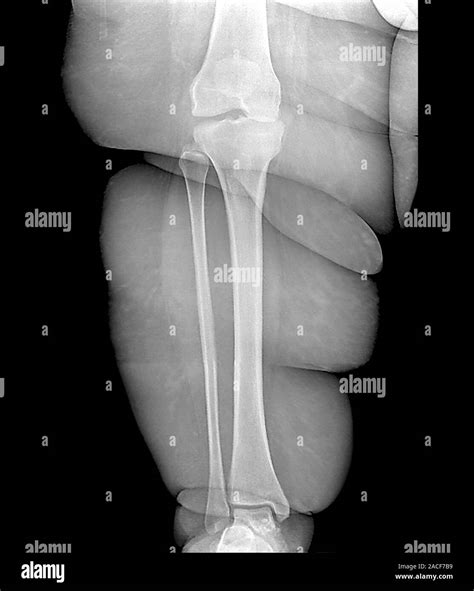 Obese person's lower leg. X-ray of the leg of a 23 year old patient who ...
