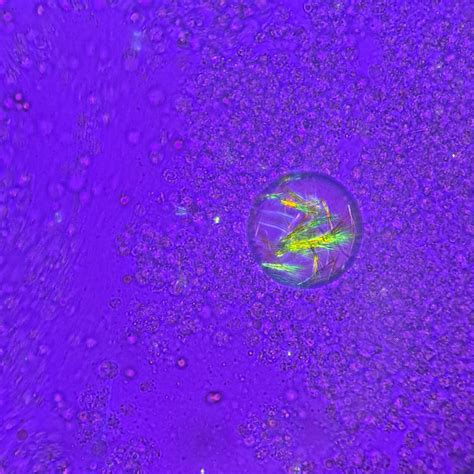 Body Fluid Crystals: Identification and Clinical Significance