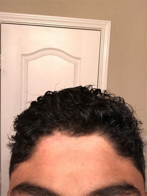 15, male, why is my hairline so messed up? What are some good styles to ...