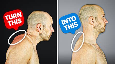 Fix Your Neck Hump FAST (10 Minutes a Day) - ZacCupples.com