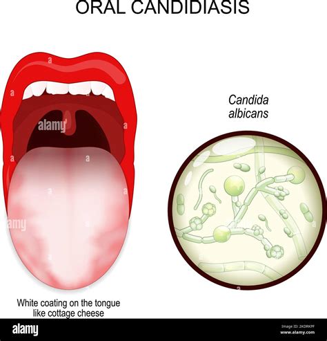 oral candidiasis. oral thrush yeast infection. White coating on the ...