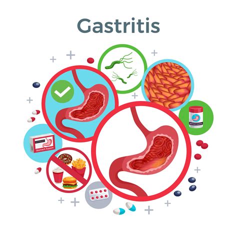 Gastritis: Causas, Tipos Y Prevención – EFHEC