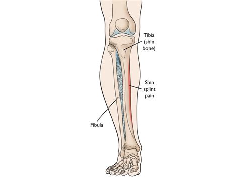 Shin Splints - Podiatry Quest