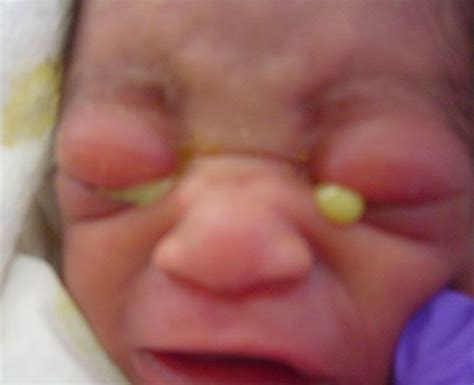 chlamydia eye discharge