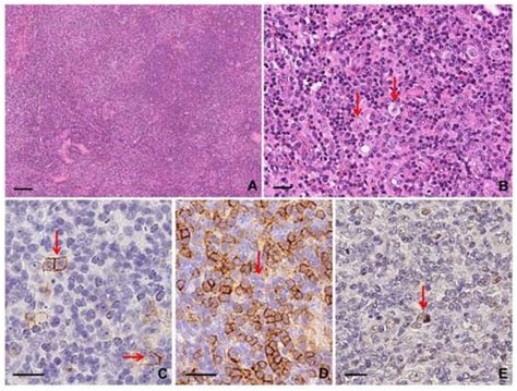 Hodgkin Reed–Sternberg-Like Cells in Non-Hodgkin Lymphoma