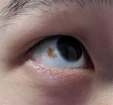 Brown Spot On Eye