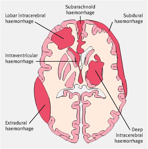 Subdural Hemorrhage Vs Subarachnoid Hemorrhage