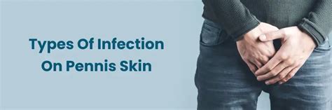 Types of Infection on Penis Skin: Full Guide