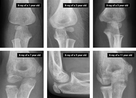 Xrays Elbow How To Approach The Pediatric Elbow EMRA