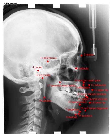 Automatic Cephalometric Landmark Detection on X-ray Images Using a Deep ...